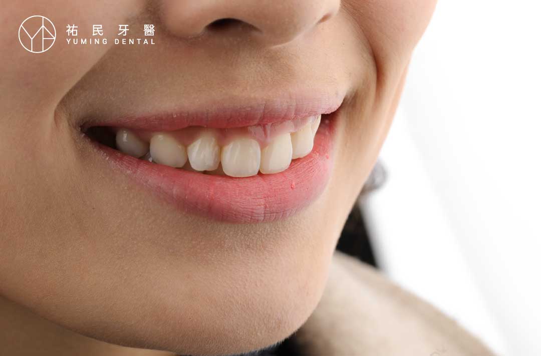 笑露牙齦讓微笑比例變得不好看，是很多人感到困擾的問題。