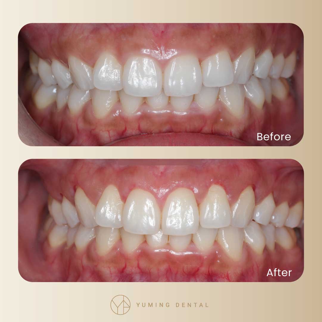 水雷射牙齦美容前後對比。手術過程中要修到「齒槽骨」，牙齦才不會又復長喔！