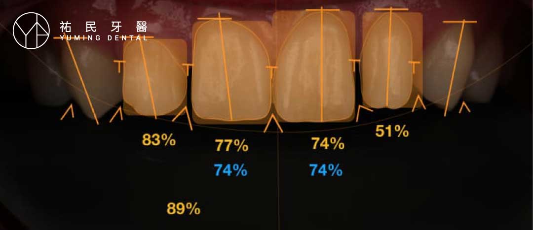楊醫師以DSD微笑曲線設計，將原本較小的牙齒，重新設計新的形態、大小。