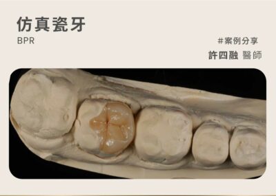 仿真瓷牙案例：職人美學精神 用完美齒雕重建健康牙齒