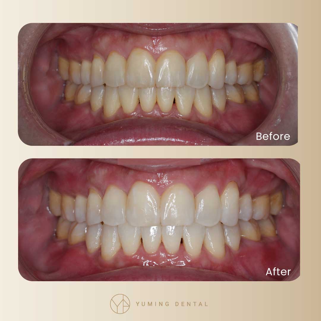 透過低溫冷光美白，只需要30-45分鐘，就能完成3-8色階的牙齒美白。