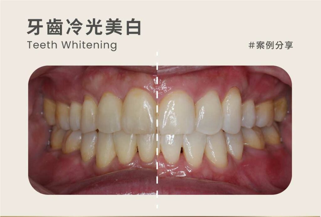 牙醫冷光美白案例：午休冷光美白 1小時牙齒就能偷偷變白