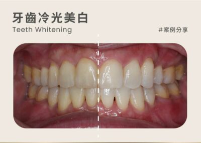 牙醫冷光美白案例：午休冷光美白 1小時牙齒就能偷偷變白