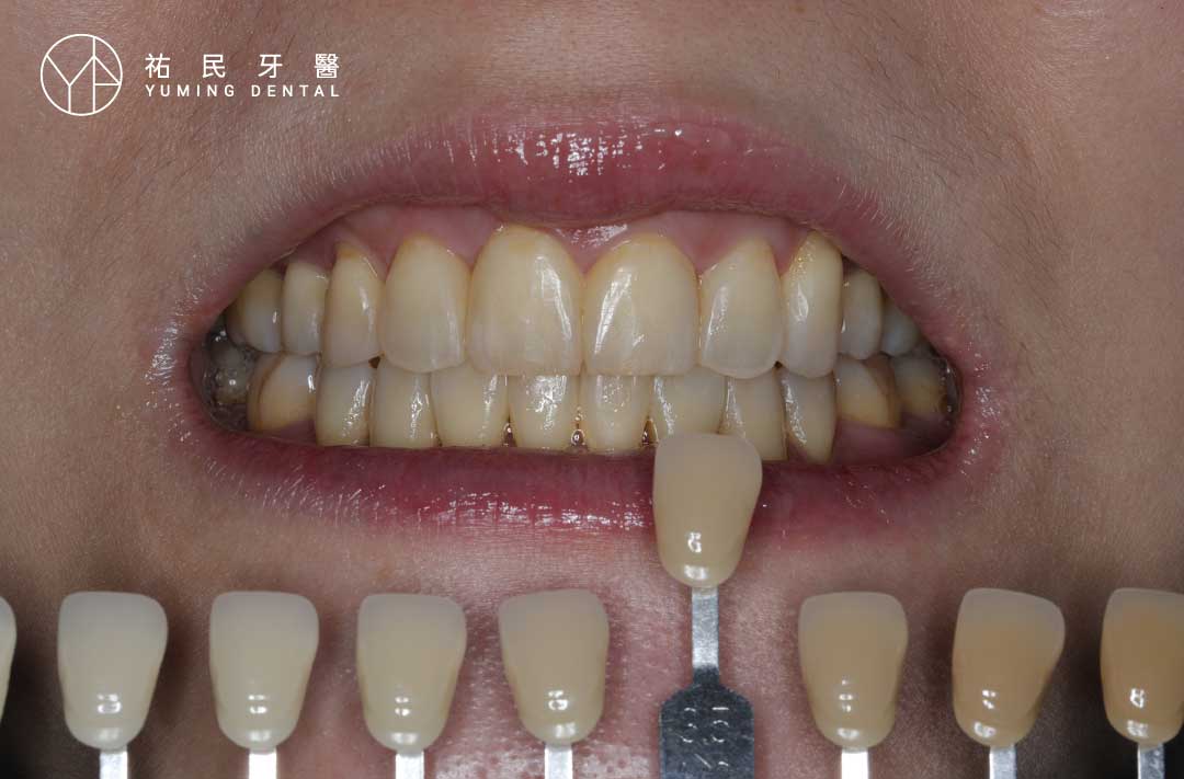 牙醫冷光美白前比色，牙齒較黃、較暗