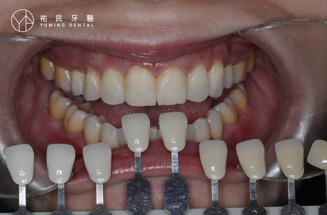 結束牙醫冷光美白療程也會再做一次牙齒比色，比色後可以看到牙齒提高3-5個色階。