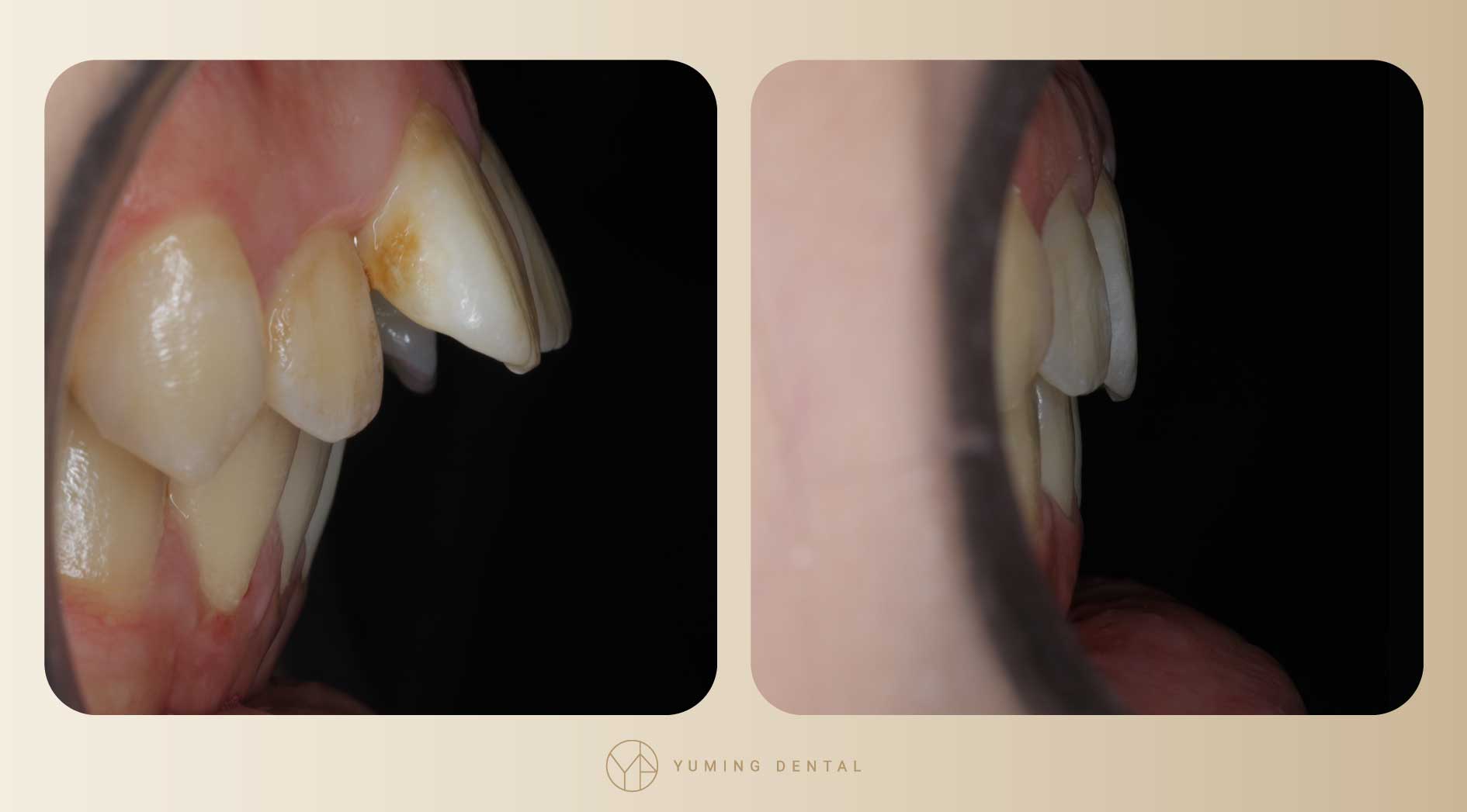 經過矯正後，暴牙情形改善許多，將原本外凸的牙齒往內收。