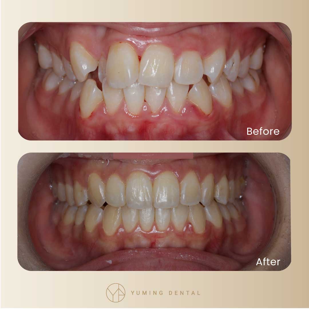 矯正前後對比圖1。矯正前後比對，原本牙齒凌亂的情形大幅改善。