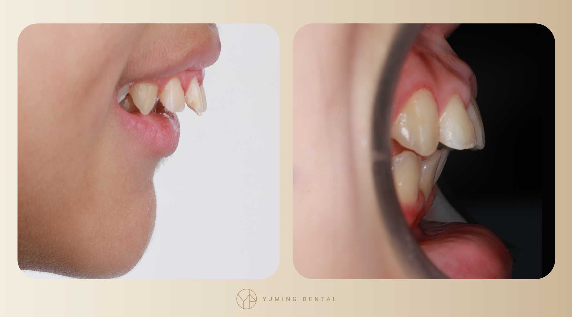矯正前期，前牙明顯往後收，暴牙情形改善許多，下巴線條也明顯改變。