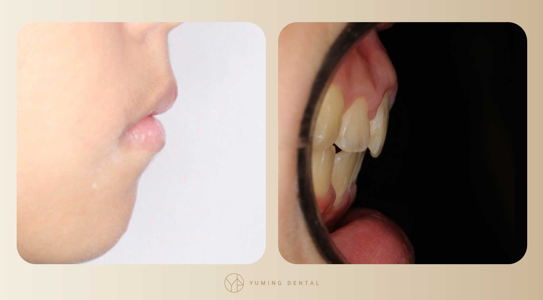 矯正療程結束，暴牙及嘴凸的情形大幅改善。