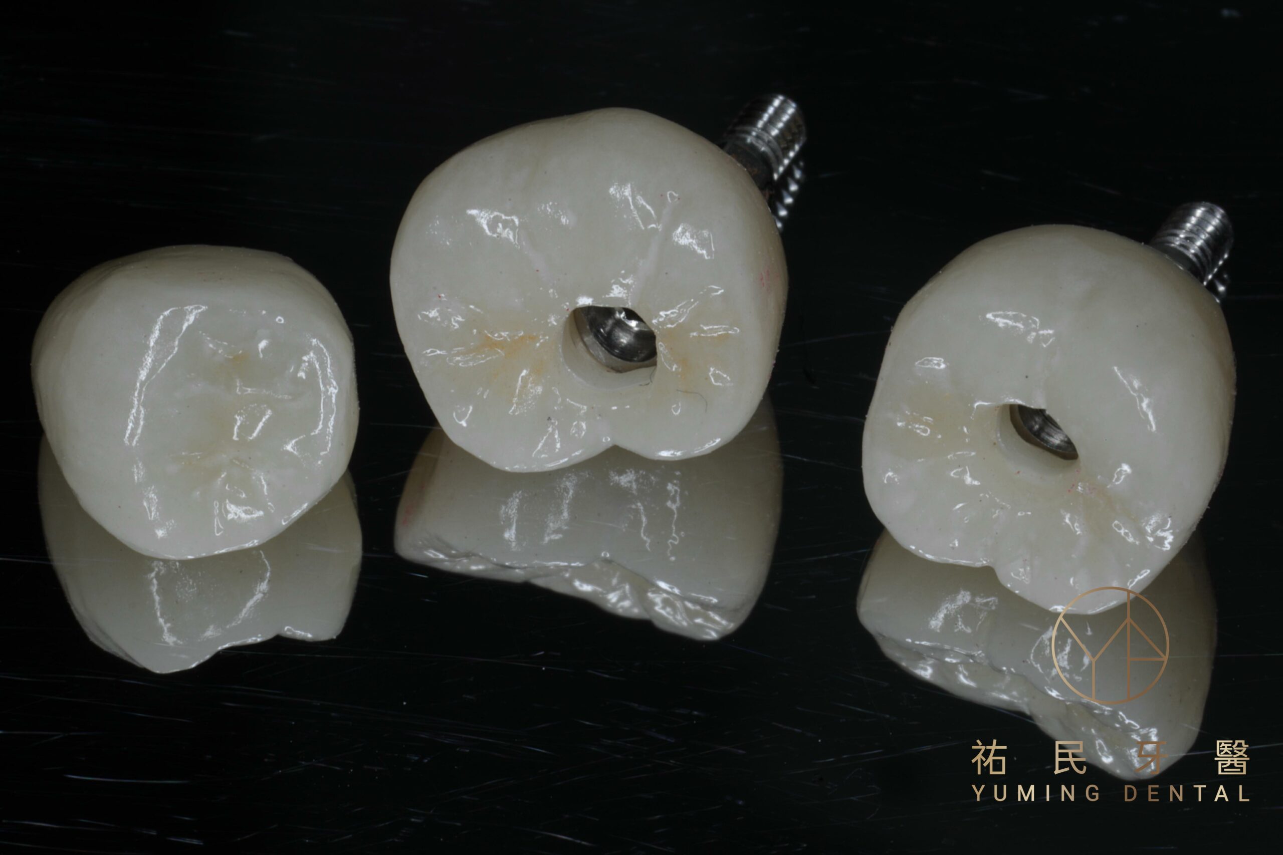 植體手術後需待植體穩固後，才能進行假牙安裝