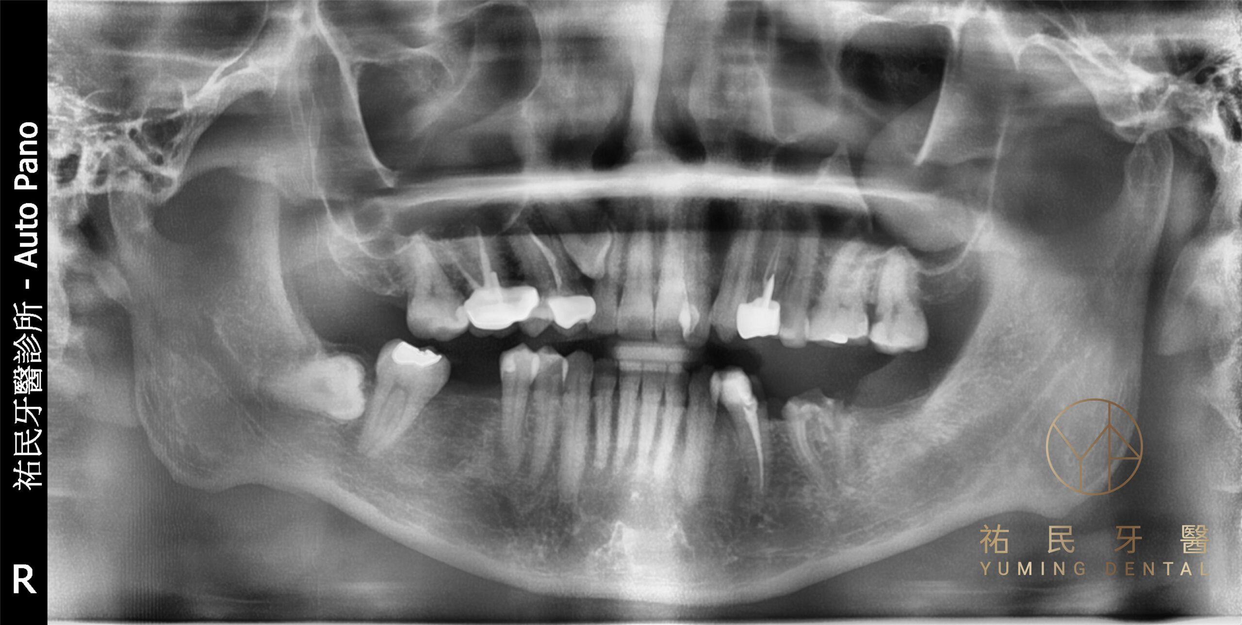 缺牙不補會造成咬合不正、牙齒傾斜、咀嚼困難會進而影響身體健康