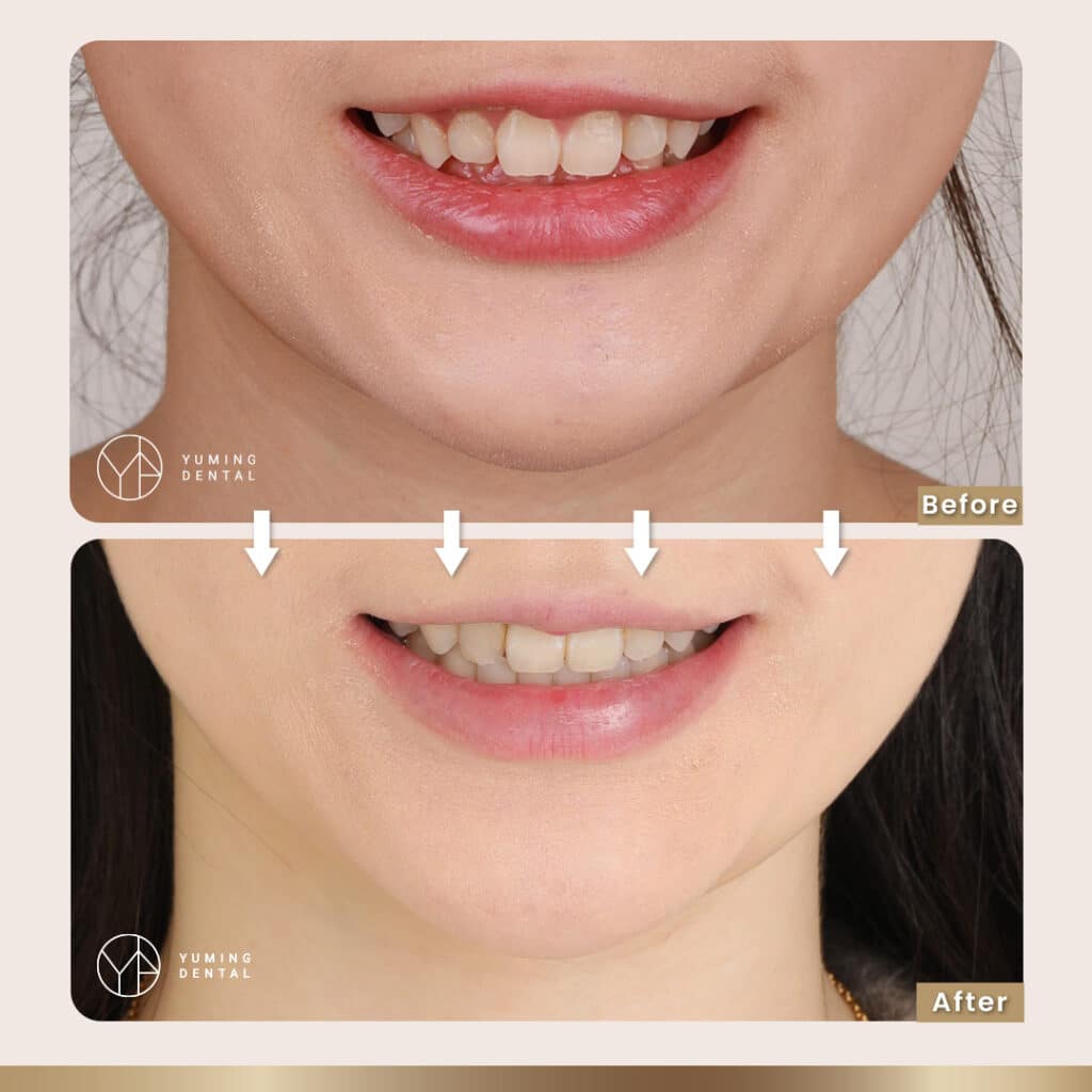 ▲把牙齒歸位，下巴自然會跳到適當的位置，這案例就是深咬修改完臉型變很好看的案例