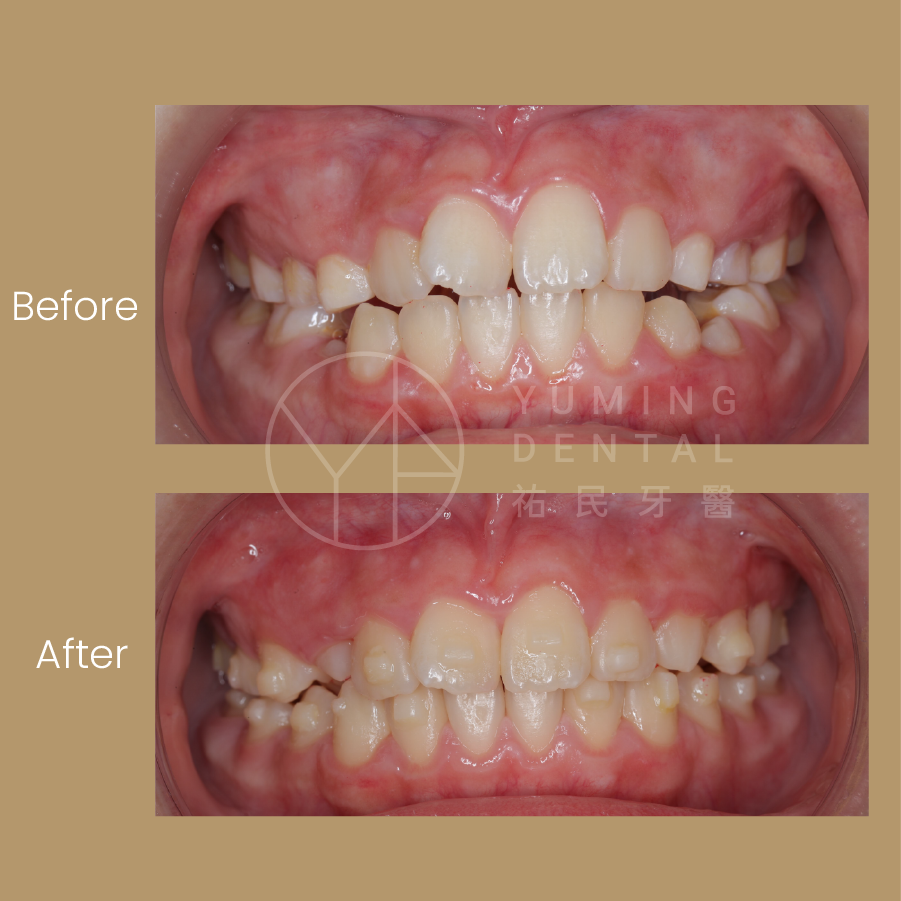 此案例使用兒童隱適美矯正結束後，恆牙順利長出，牙齒位置也排整齊