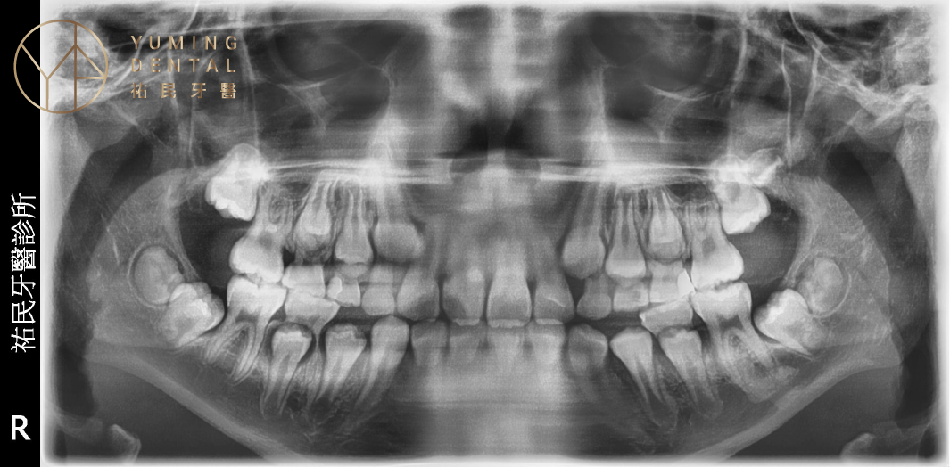 混合齒列期口腔內是兒童矯正黃金期，使用兒童隱適美可以為恆牙預留空間