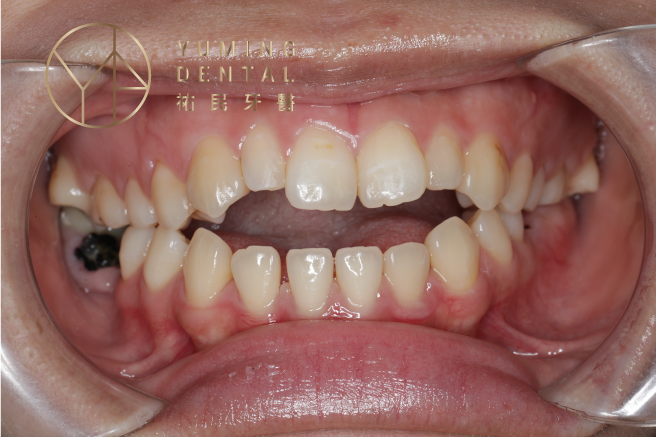 牙齒咬合不正常見類型－開咬：上門牙咬不到下門牙，唇形會凸或嘴巴閉不起來