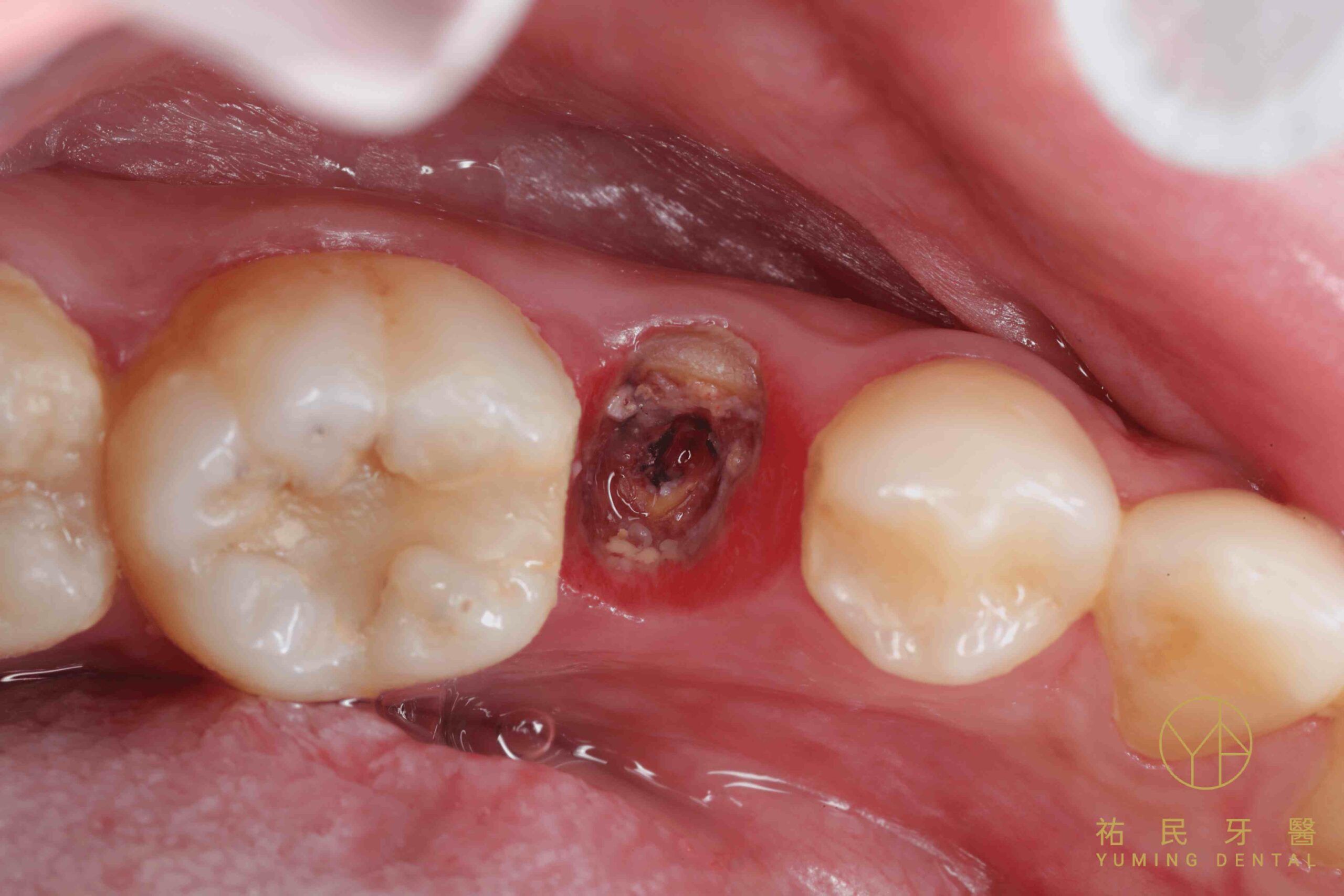 牙冠已經損壞只剩下牙根牙根斷裂一定要拔，並且後續補上植牙