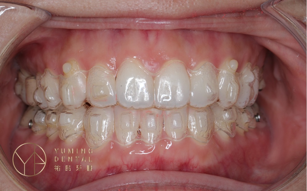 ▲透明牙套的包覆特性，也導致出現一些隱適美缺點