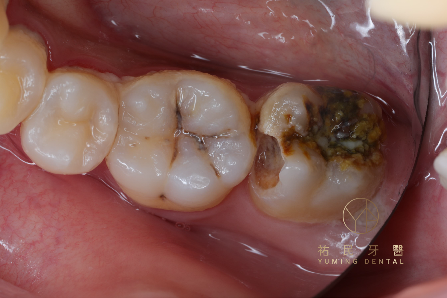 深度蛀牙需要進行根管治療或是視情況可進行活髓治療