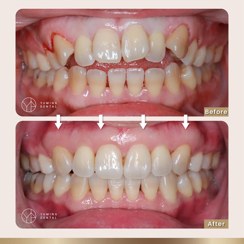 ▲「開咬」是牙齒咬合不正最常見的類型，上門牙咬不到下門牙，唇形會凸或嘴巴閉不起來。
