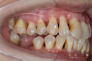 適當的修形牙齒，可以使牙齒收進來進而將輕微暴牙矯正，同時解決黑三角的問題