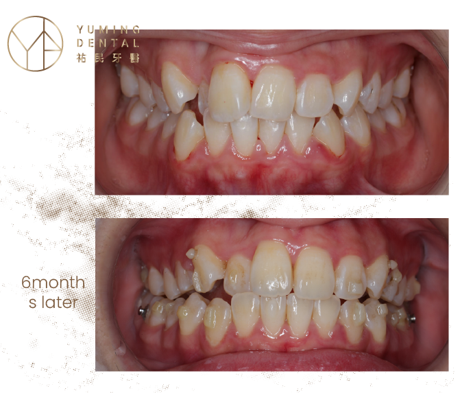 此案例在使用隱適美加速器6個月後，牙齒不整齊的情況就改善很多