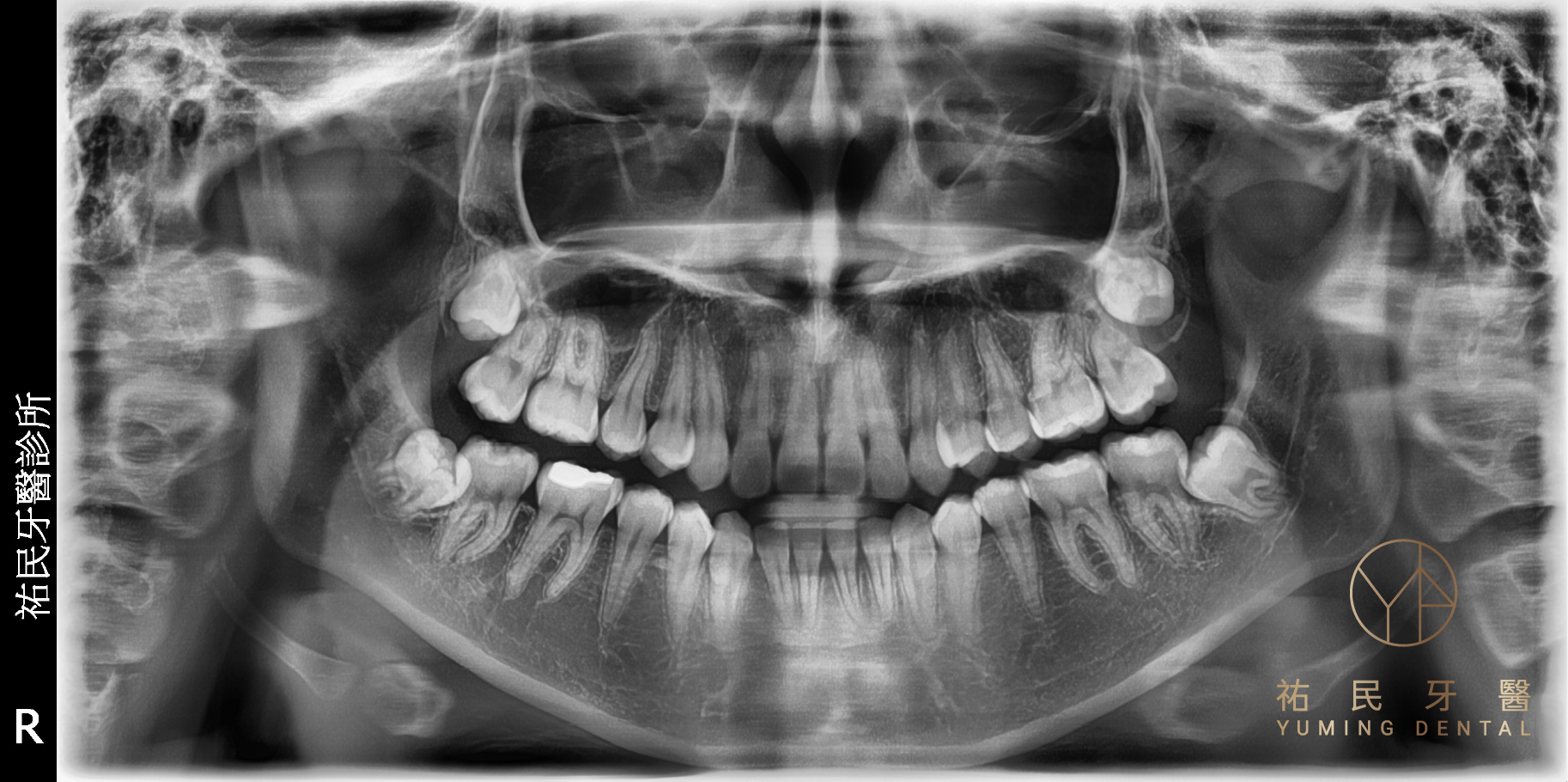 究竟智齒一定要拔嗎？主要會由醫師判斷，可透過拍攝牙齒X光片近一步了解牙齒狀況