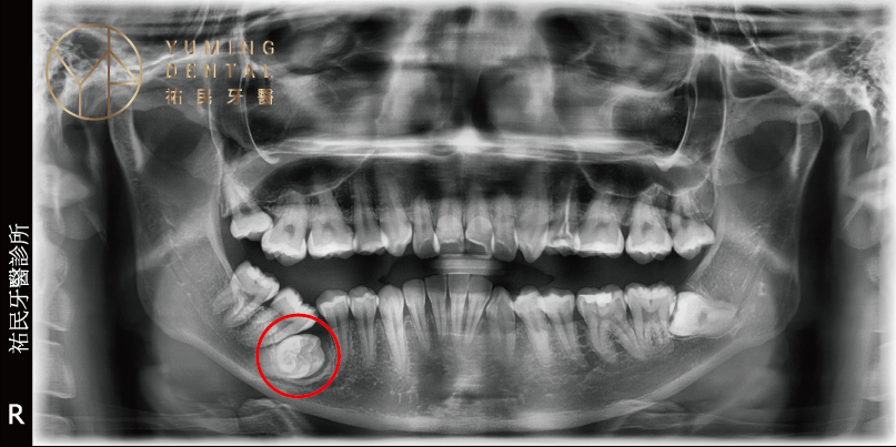 無法解決埋伏齒的矯正案例是隱適美缺點，因為必須先將牙齒都拉至牙齦上，才能做矯正牙套