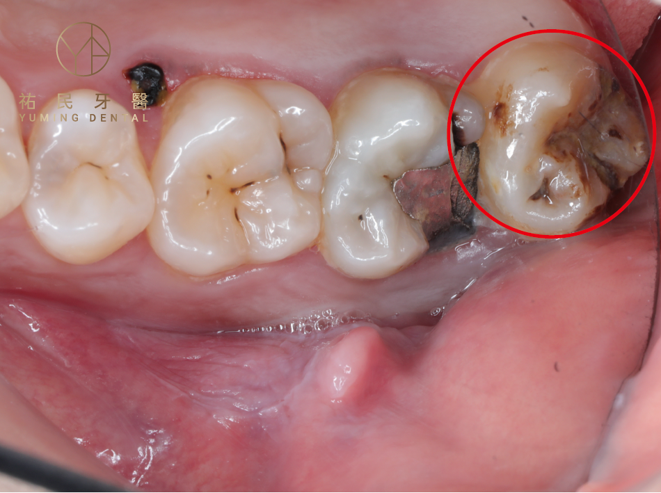 智齒一定要拔的情況如：嚴重蛀牙，不僅會影響到口腔清潔、也會造成牙周問題。