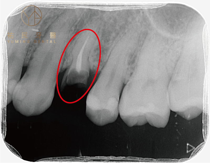 從X光片可看出只剩殘留的牙根，必須拔掉才不會造成牙周與感染問題