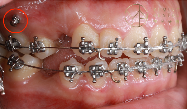 矯正骨釘可以作為牙齒矯正施力的定點，將牙齒往後拉