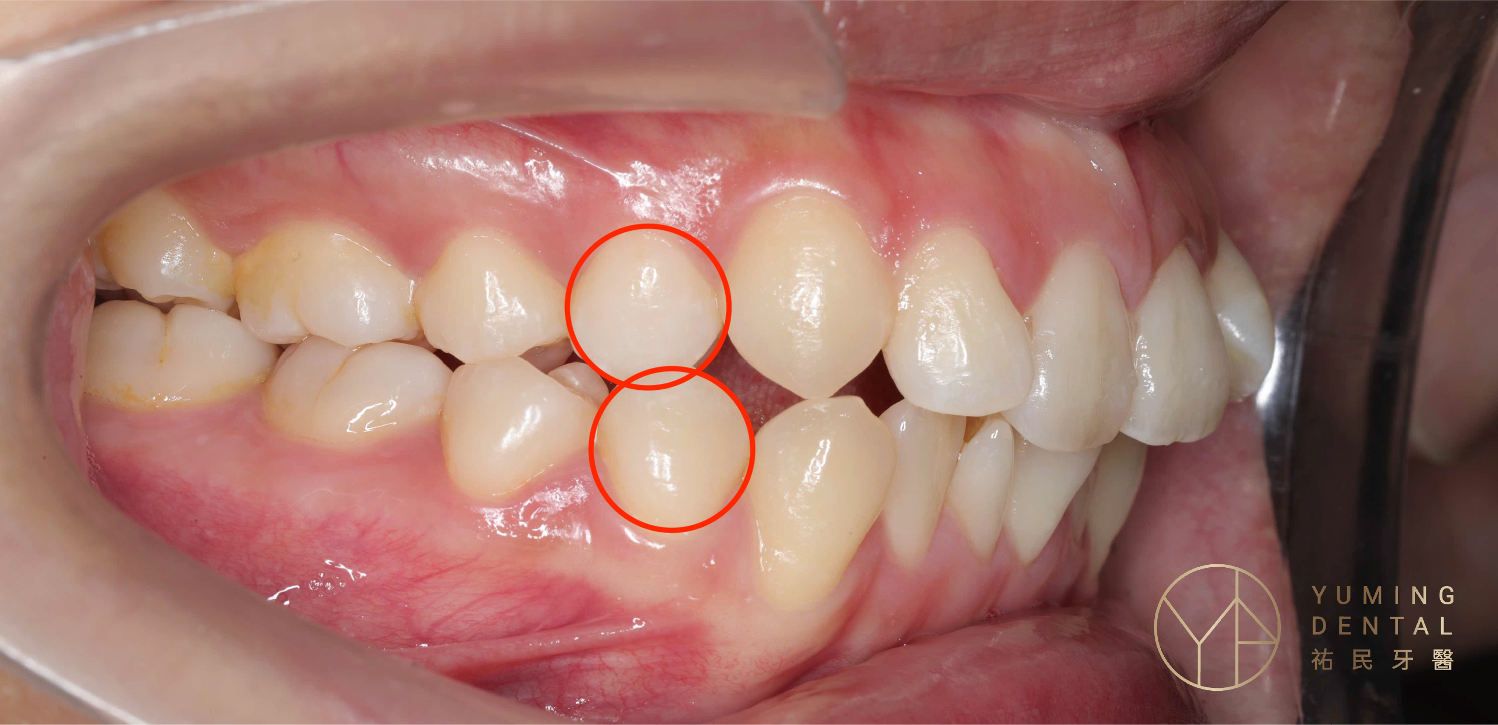 矯正牙齒拔牙通常是拔掉「第一小臼齒」