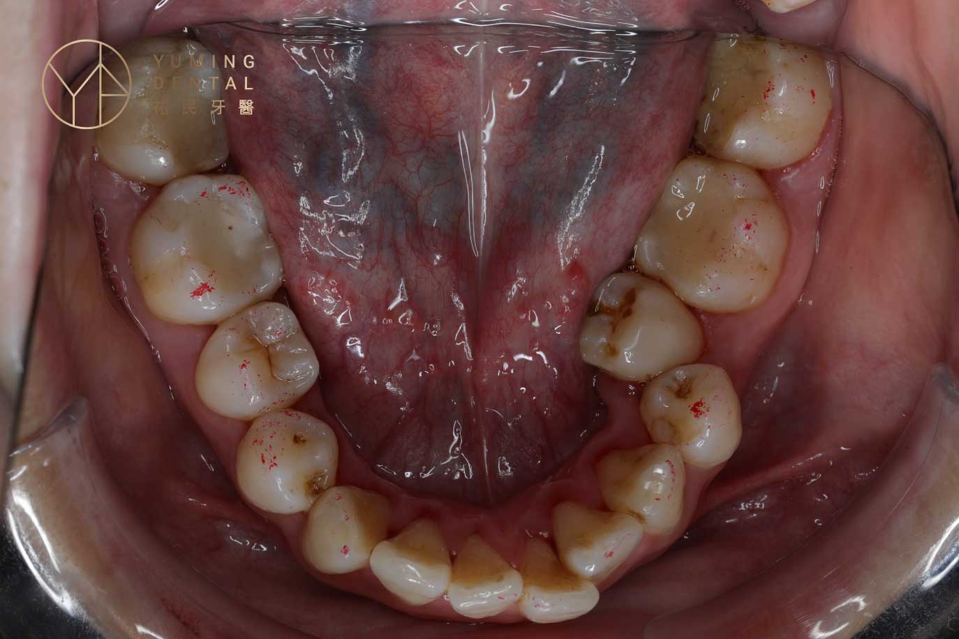 輕微暴牙矯正方式第四種就是解決牙齒的干擾：此案例的第二小臼齒因為傾倒，干擾了其他牙齒的排列。