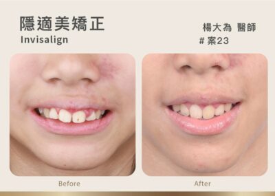 隱適美矯正案例/Invisalign case