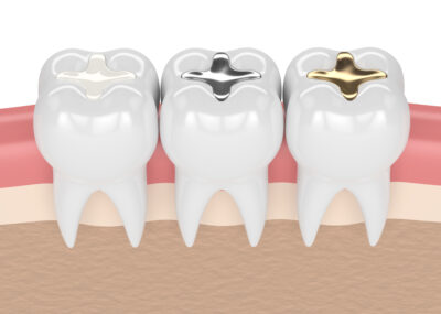 補牙材質差異