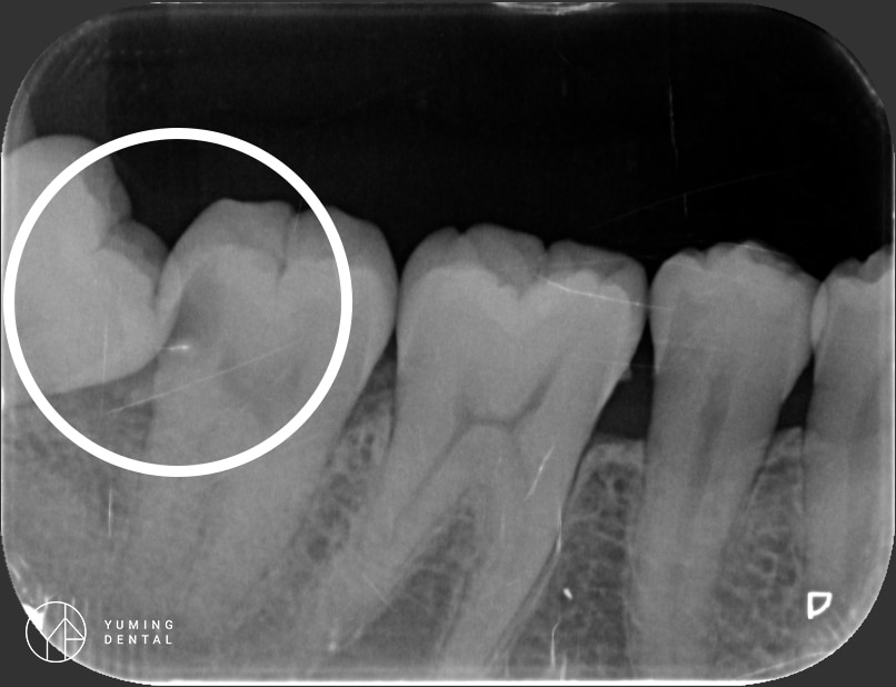 ▲圈起處為深度蛀牙的牙齒