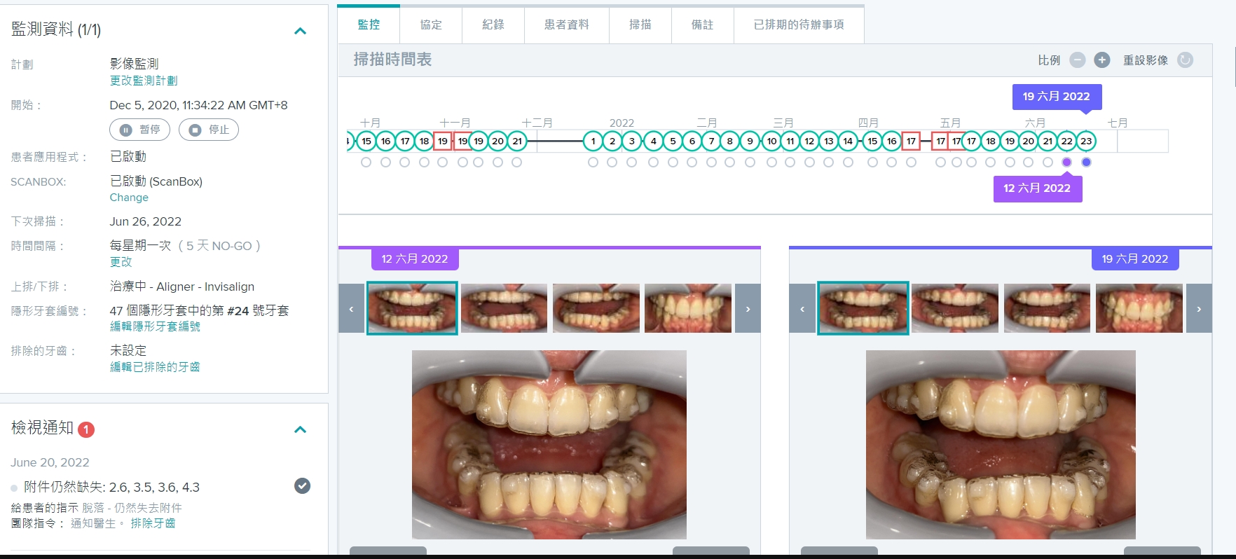 牙科監控系統Dental Monitoring