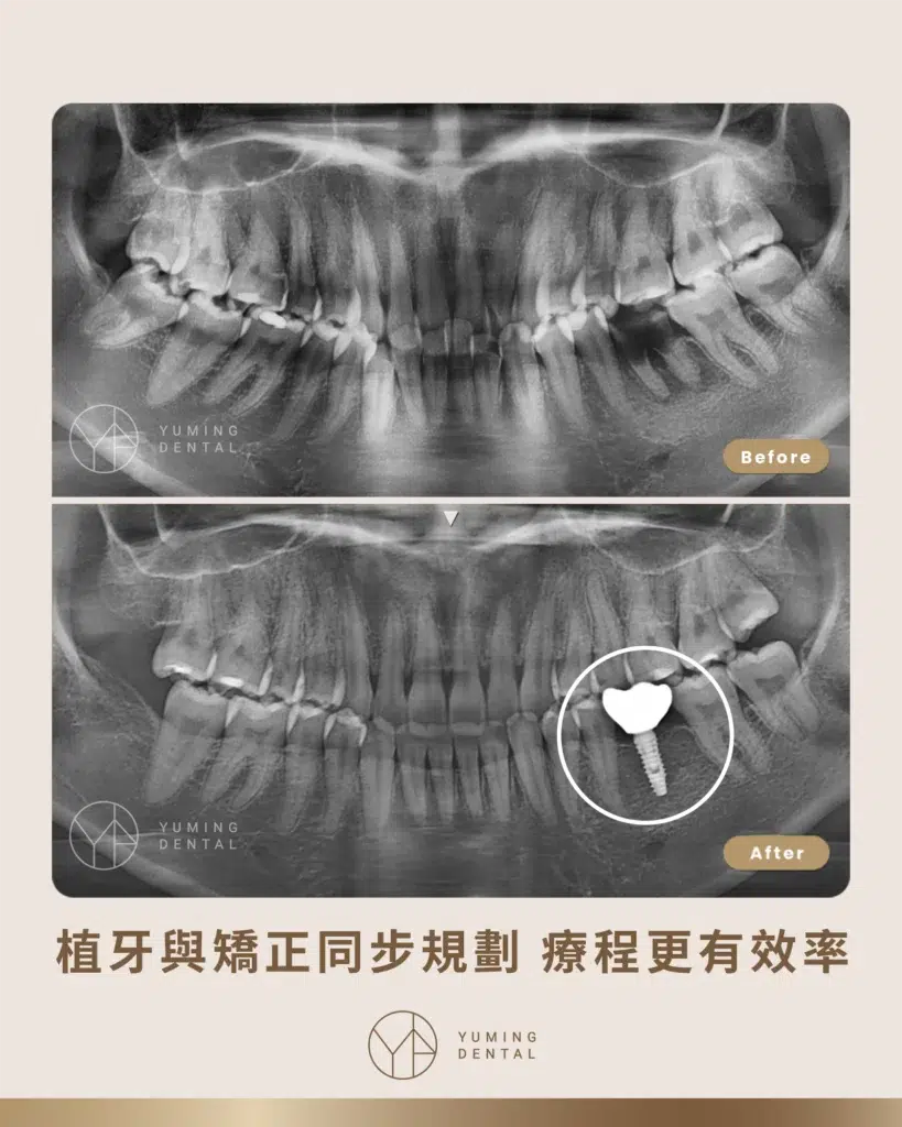 植牙與矯正同步進行案例