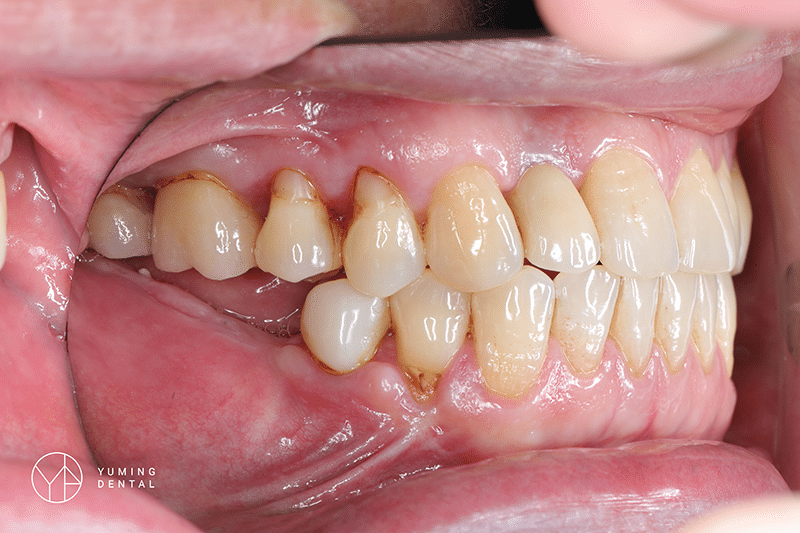 缺牙過久導致咬合不正，需要做全口重建