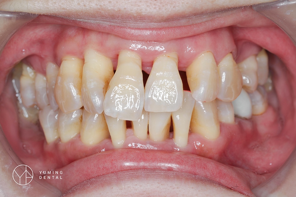 牙周病導致牙齦萎縮，需要進行全口重建