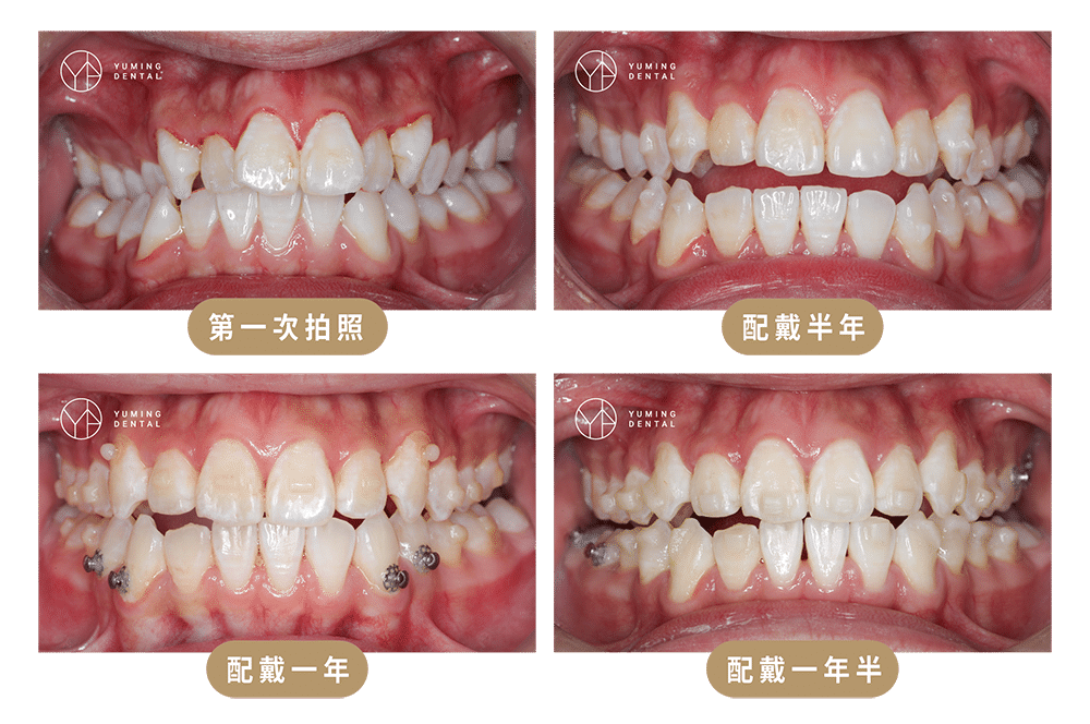 ▲原先牙齒咬合不正的案例，透過隱適美矯正達到正常咬合。