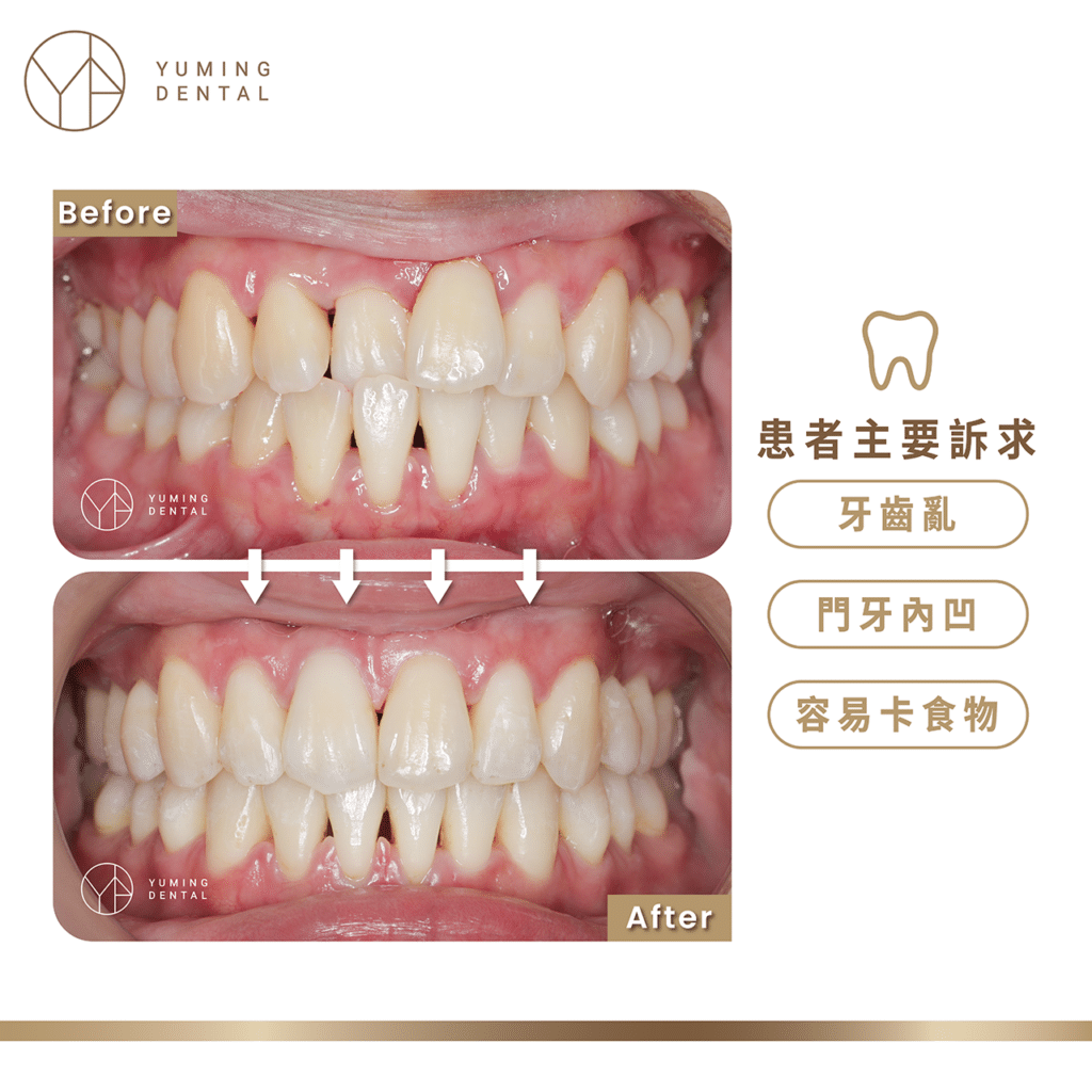 隱適美矯正案例分享｜門牙排列不整－祐民牙醫 楊大為醫師366 Invisalign case - 祐民牙醫