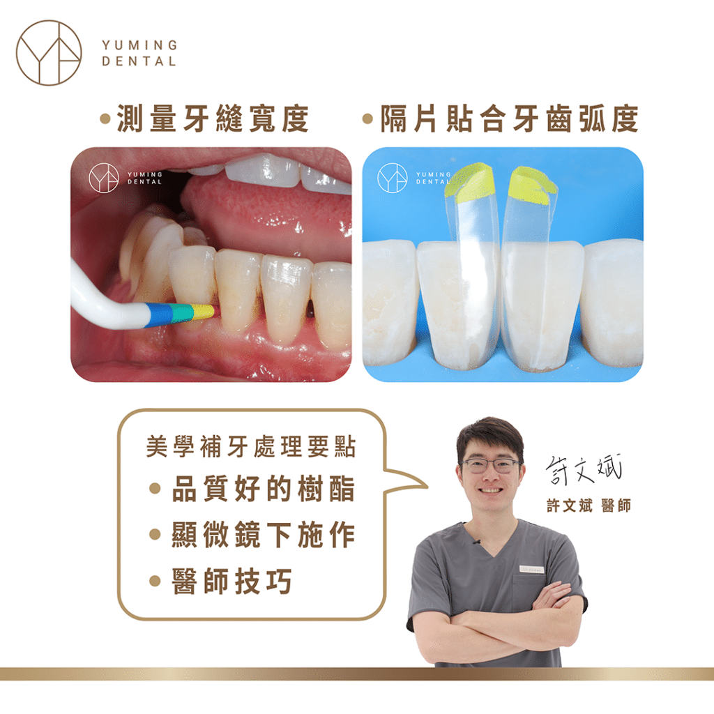 美學補牙案例分享｜黑三角縫－祐民牙醫 許文斌醫師 Filling case - 祐民牙醫