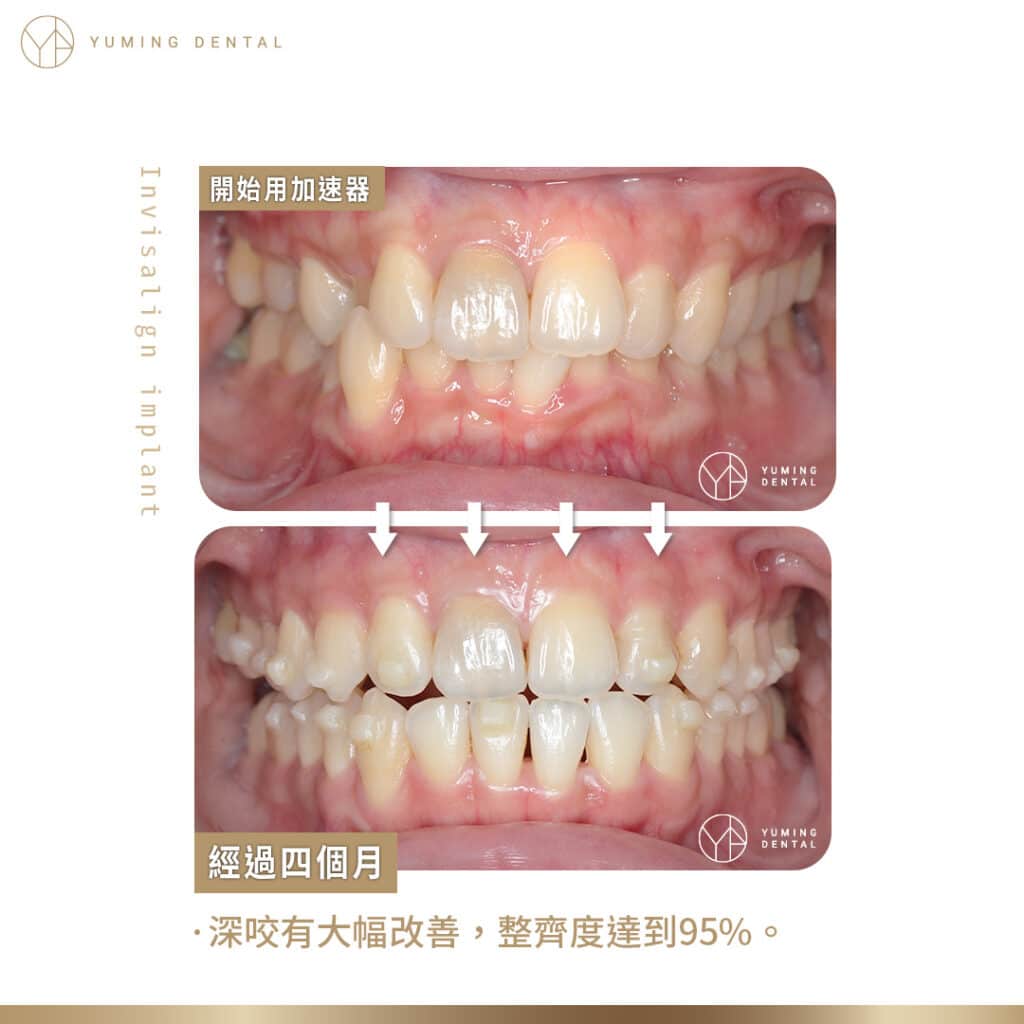 透過隱適美加速器，四個月後深咬的情形有大幅改善，牙齒排列更整齊