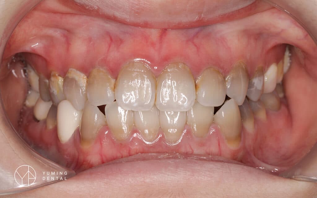 四環黴素導致牙齒變黃，需要透過 牙齒美白 才能改善
