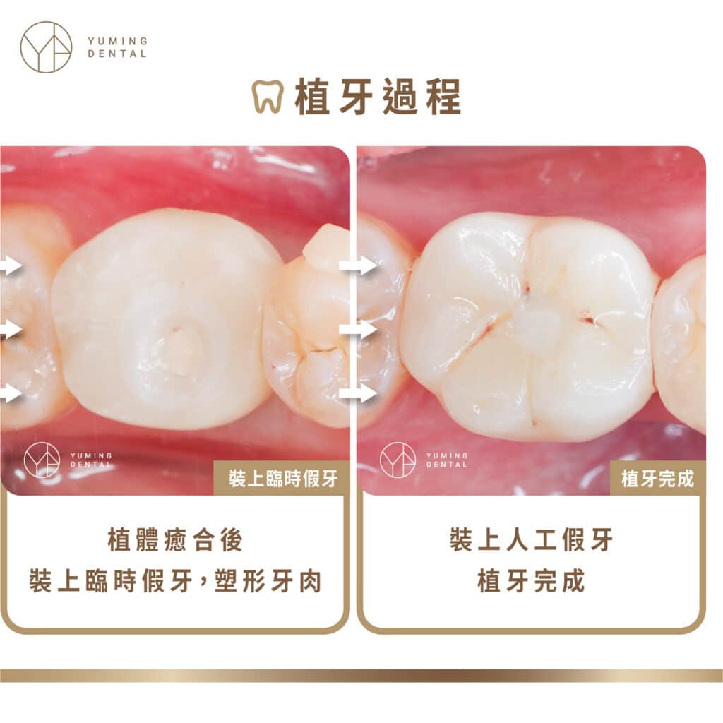 裝上臨時假牙，幫助牙肉塑形，假牙完成後，醫師再將假牙安裝到患者口腔內