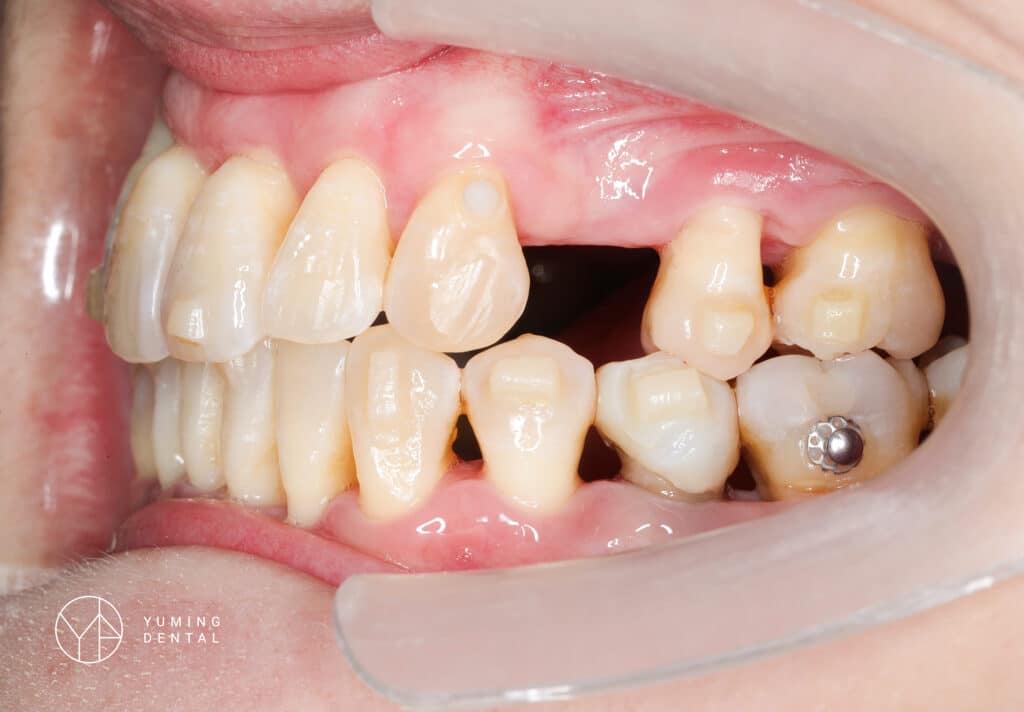 有植牙可以同時做隱適美矯正嗎？其實 植牙和牙齒矯正 可以同時進行！