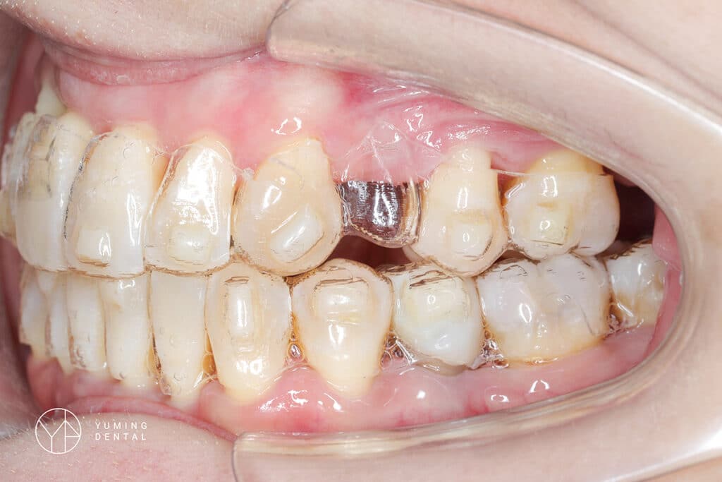 ▲隱適美牙套可以預留植牙位置