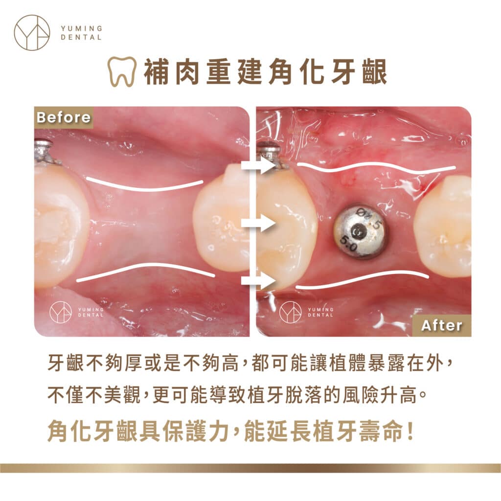 ▲補肉重建角化牙齦