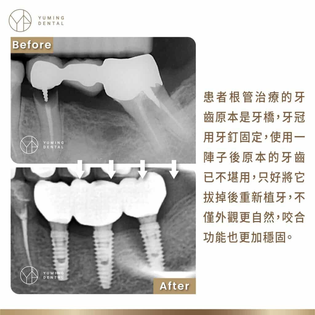 患者根管治療的牙齒原本是牙橋，牙冠用牙釘固定，使用一陣子後原本的牙齒已不堪用，只好將它拔掉後重新植牙