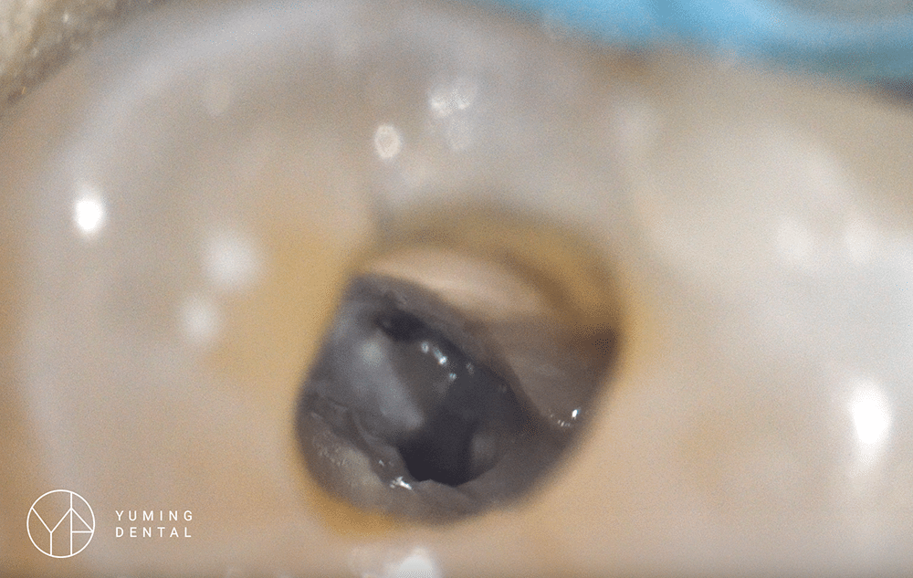 ▲顯微鏡下看根管治療的牙齒